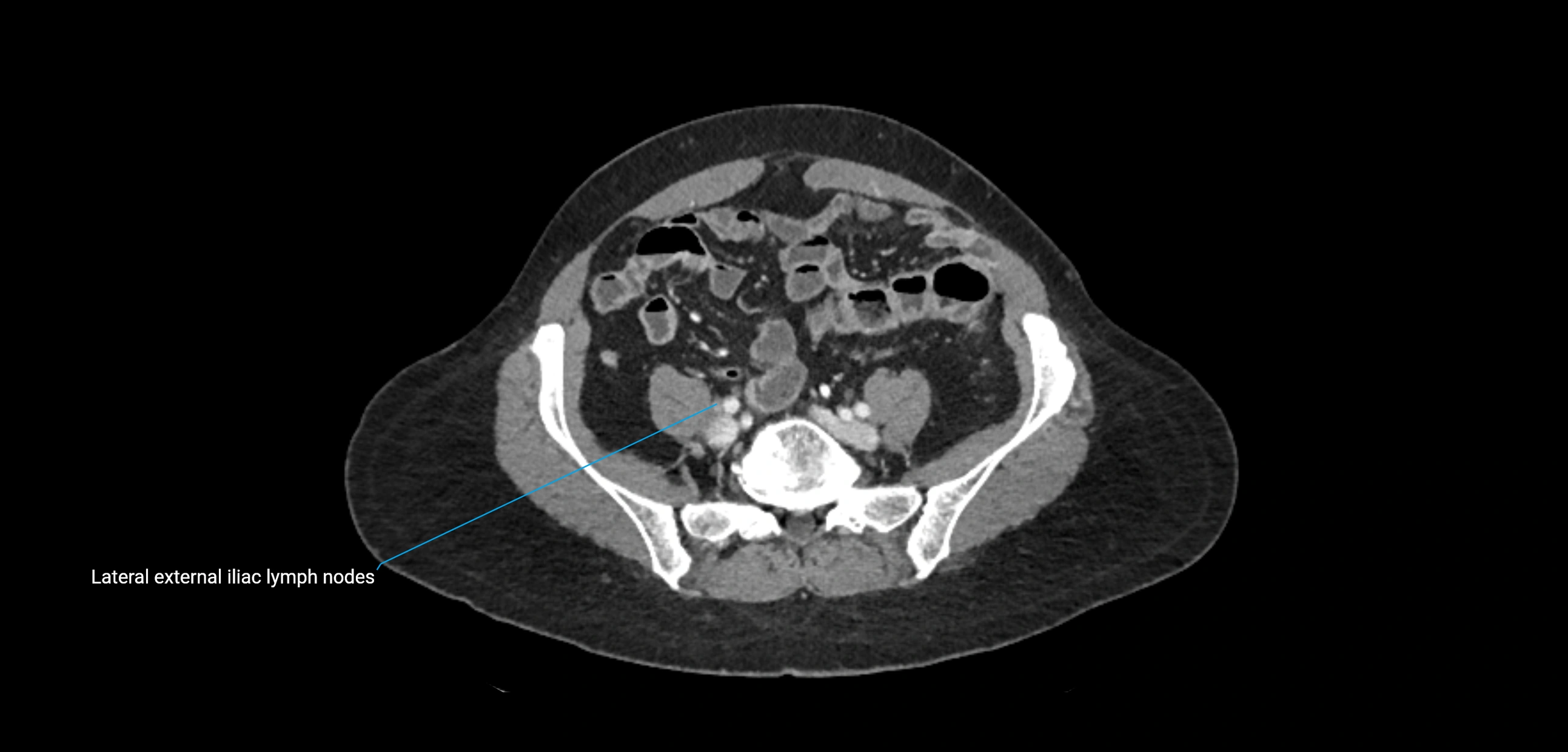 CT ct abdominal lymph nodes  axial cross sectional anatomy  enchanced radiology image -img-00002-00309.webp